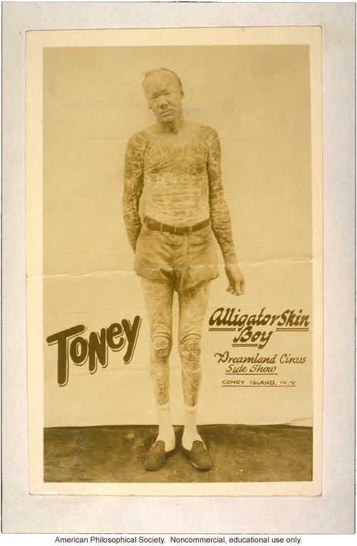 Alligator-Skinned Man