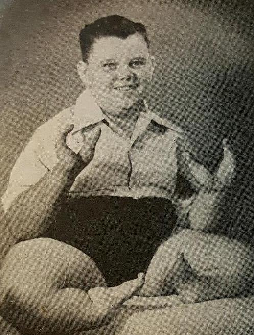 Lobster Boy